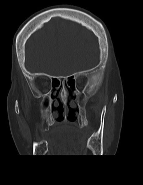 File:Burnt-out meningioma (Radiopaedia 51557-57337 Coronal bone window 14).jpg