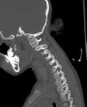 Butterfly vertebra (Radiopaedia 77903-90209 Sagittal bone window 76).jpg