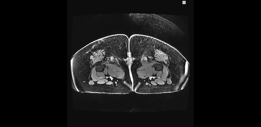 Buttock filler complications (Radiopaedia 63497-72115 Axial T1 C+ 60).jpg