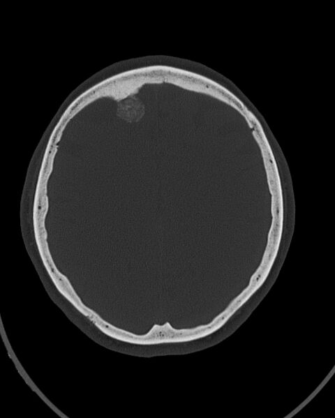 File:Calcified meningioma (Radiopaedia 74361-85243 Axial bone window 16).jpg