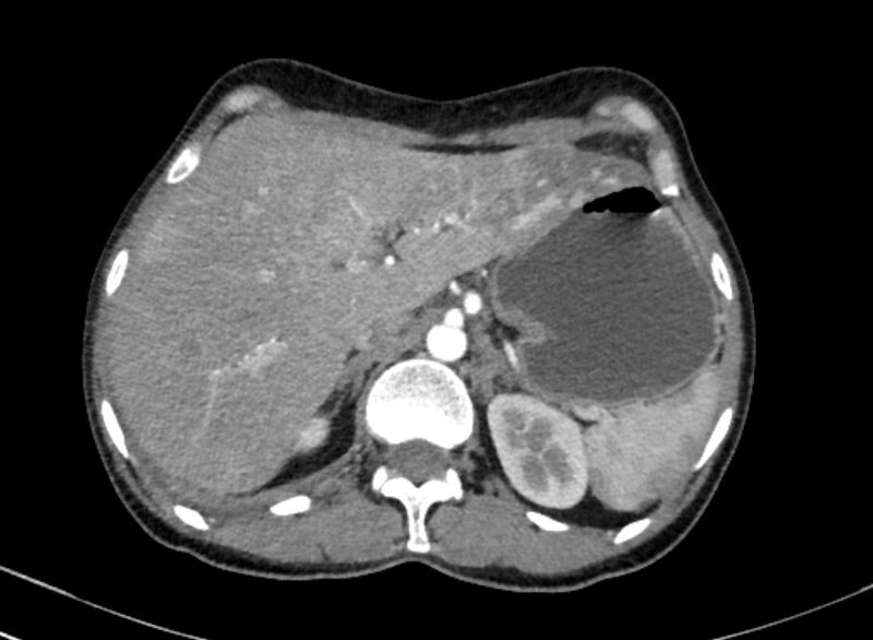 File:Cannonball metastases from breast cancer (Radiopaedia 91024-108569 A 118).jpg