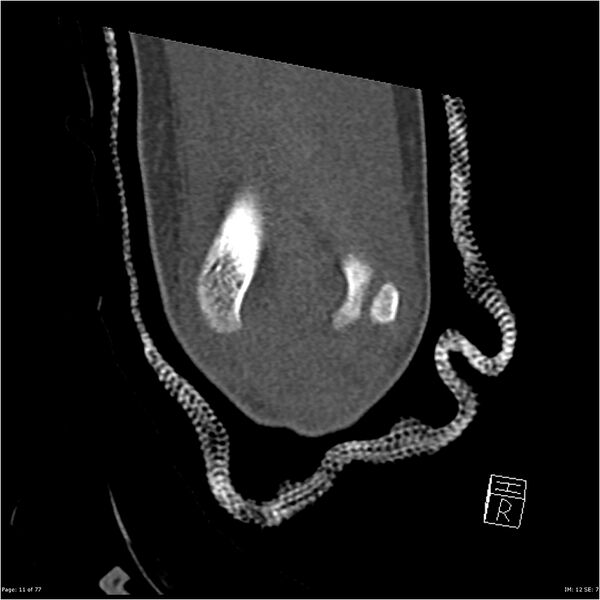 File:Capitellum fracture (Radiopaedia 23352-23426 Coronal bone window 11).jpg