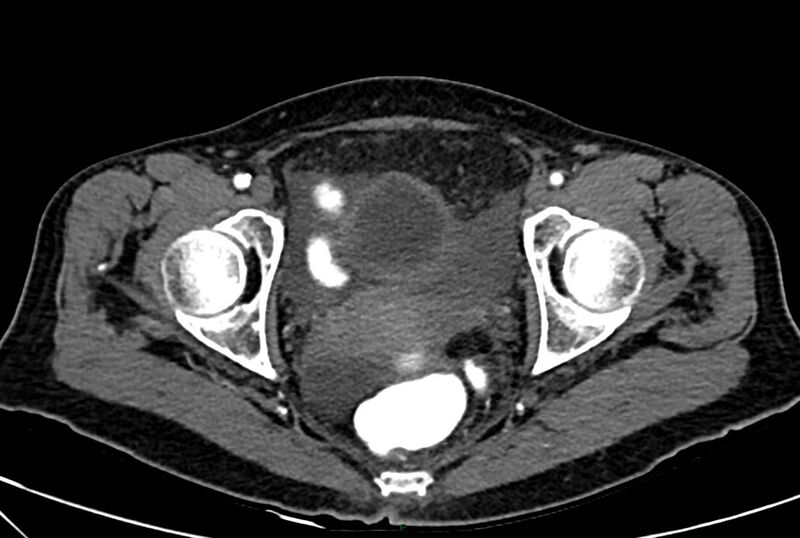 File:Carcinoid mesenteric tumor complicated by chylous ascites (Radiopaedia 76312-88926 A 71).jpg