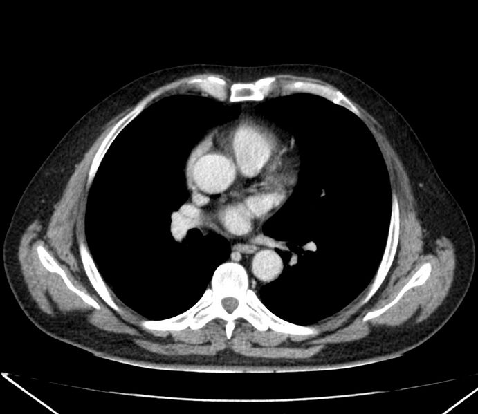 File:Carcinoid tumor with hepatic metastases (Radiopaedia 22651-22670 C 17).jpg