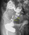 Carcinoma of rectum (Radiopaedia 27843-28086 Oblique 1).PNG