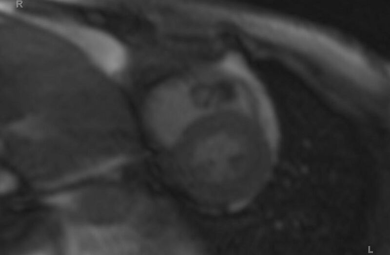 File:Cardiac hemangioma (Radiopaedia 31709-32631 Short axis 71).jpg