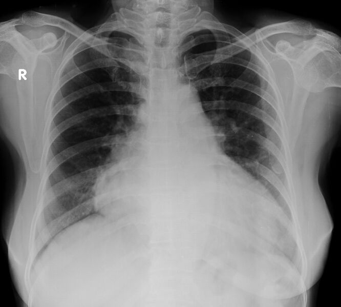 File:Cardiomegaly - mitral regurgitation (Radiopaedia 72729).jpg