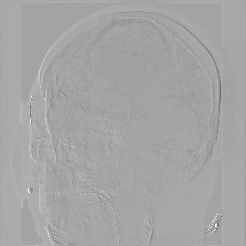 Caroticocavernous fistula - direct (Radiopaedia 61660-69666 Oblique Left ICA 54).jpg