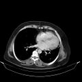 Carotid body tumor (Radiopaedia 21021-20948 A 42).jpg