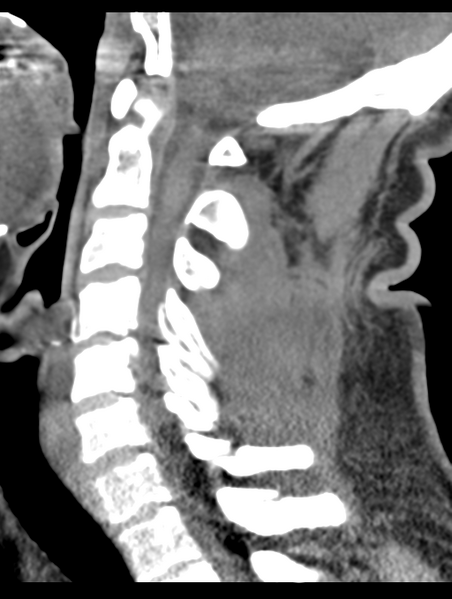 File:Cavernoma of cervical cord (Radiopaedia 50838-56346 B 43).png