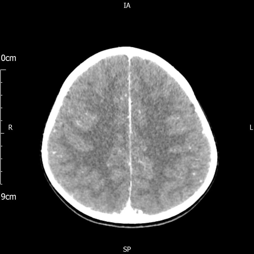 Cavernous sinus thrombosis (Radiopaedia 79414-92510 Axial Brain 137).jpg