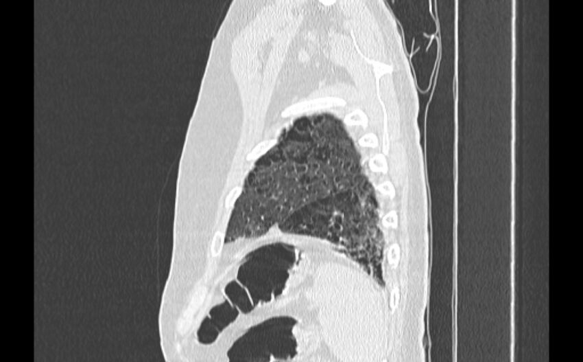 Cavitating bronchogenic carcinoma (Radiopaedia 44489-48162 Sagittal lung window 62).jpg