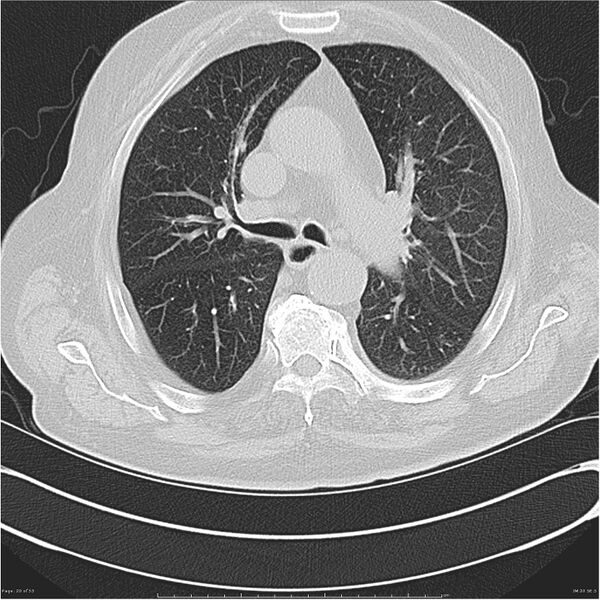 File:Cavitating left lower lobe lesion - squamous cell lung cancer (Radiopaedia 27749-28176 Axial lung window 20).jpg