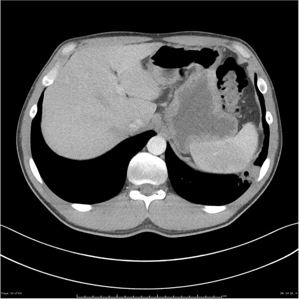 File:Cavitating lung cancer (Radiopaedia 25796-25945 C+ arterial phase 56).jpg