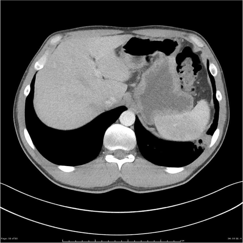 Cavitating lung cancer (Radiopaedia 25796-25945 C+ arterial phase 56).jpg