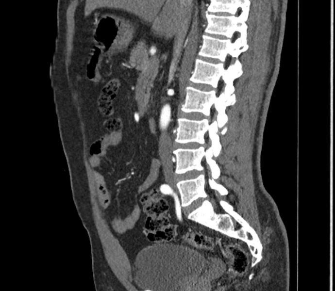 File:Celiac artery dissection (Radiopaedia 52194-58080 B 38).jpg