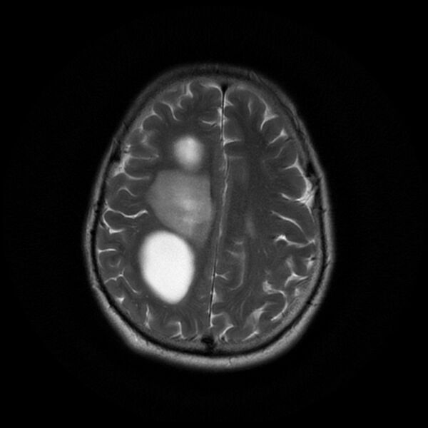 File:Central neurocytoma (Radiopaedia 67618-77021 Axial T2 19).jpg