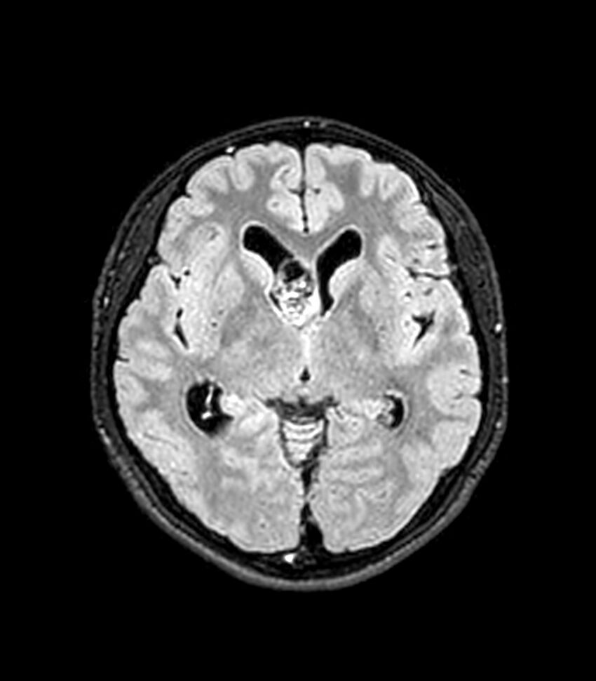 Central neurocytoma (Radiopaedia 79320-92380 Axial FLAIR 170).jpg