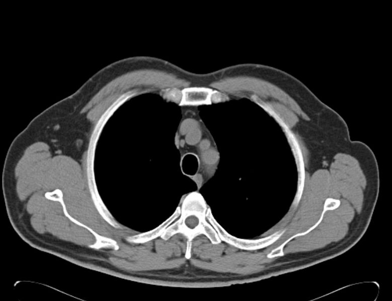 File:Centrilobular pulmonary emphysema (Radiopaedia 26808-26971 Axial non-contrast 9).jpg