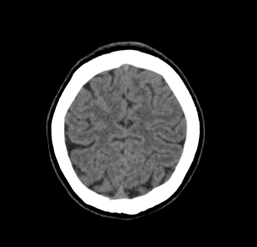 Cerebellar agenesis (Radiopaedia 30203-30817 Axial non-contrast 42).jpg