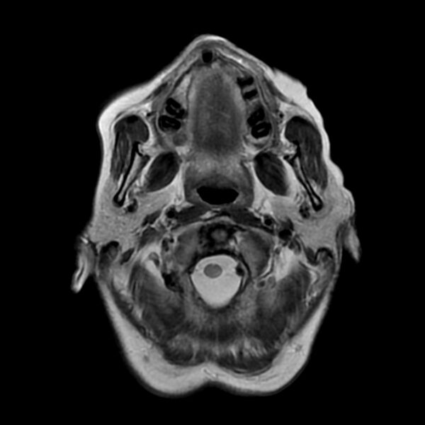 File:Cerebellar ataxia with neuropathy and vestibular areflexia syndrome (CANVAS) (Radiopaedia 74283-85159 Axial T2 2).jpg
