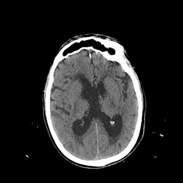 File:Cerebellar metastasis - lung tumor (Radiopaedia 69317-79145 Axial non-contrast 19).jpg