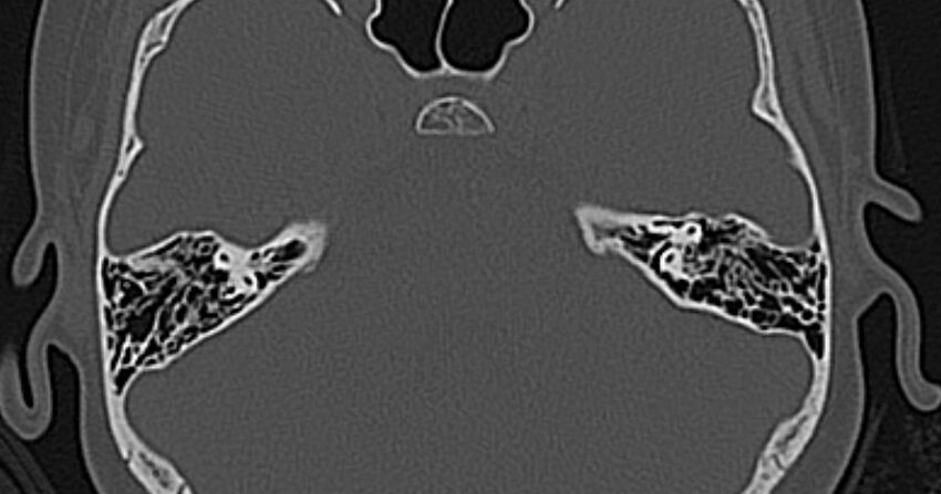 Cerebellopontine angle lipoma (Radiopaedia 57303-64242 Axial bone window 42).jpg