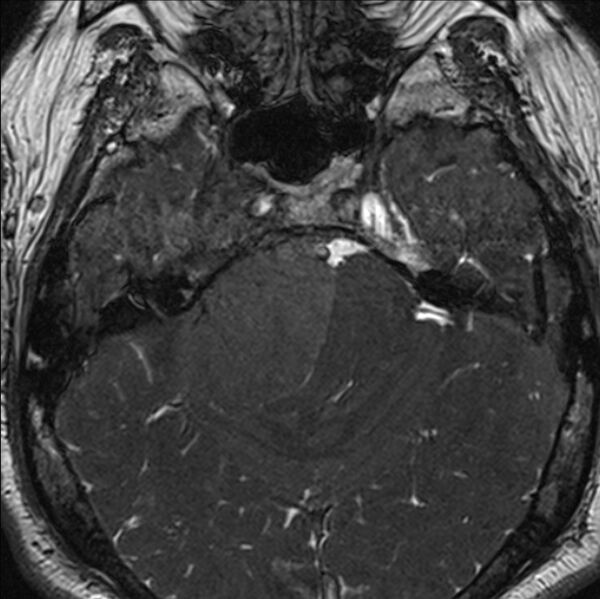 File:Cerebellopontine angle meningioma (Radiopaedia 24459-24764 I 27).jpg
