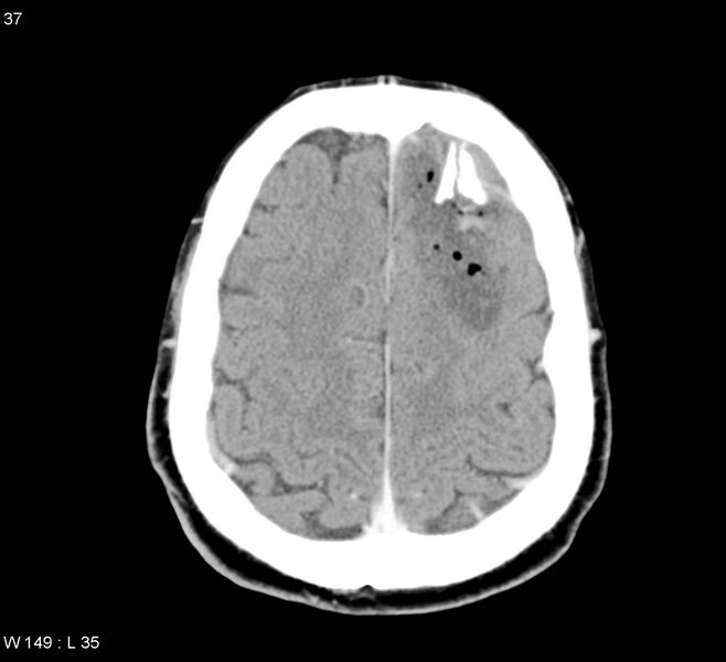 File:Cerebral abscess (Radiopaedia 5150-6933 Axial C+ delayed 6).jpg