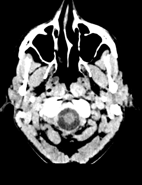 File:Cerebral abscess (Radiopaedia 60342-68008 Axial non-contrast 4).png