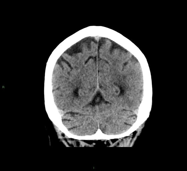 File:Cerebral amyloid angiopathy-associated lobar intracerebral hemorrhage (Radiopaedia 58376-65511 Coronal non-contrast 18).jpg