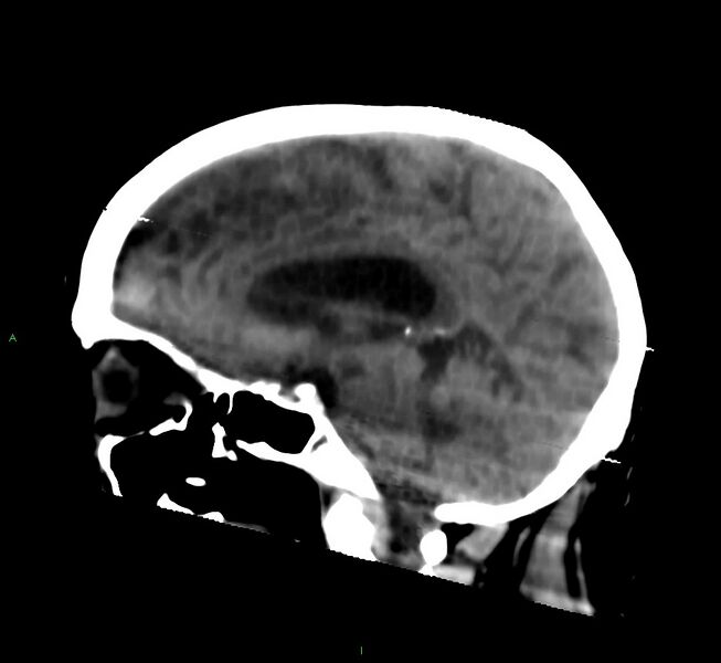 File:Cerebral amyloid angiopathy-associated lobar intracerebral hemorrhage (Radiopaedia 58377-65514 B 26).jpg