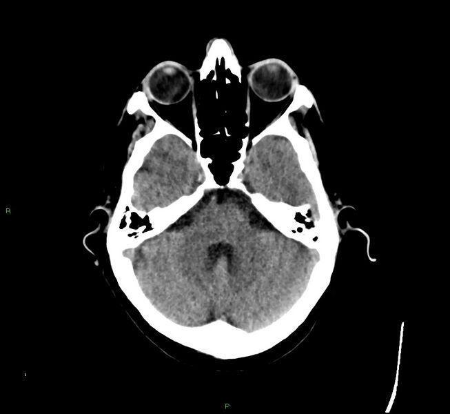 File:Cerebral amyloid angiopathy-associated lobar intracerebral hemorrhage (Radiopaedia 58529-65681 Axial non-contrast 38).jpg