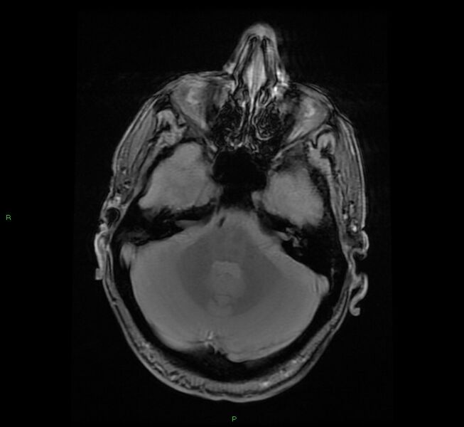 File:Cerebral amyloid angiopathy-associated lobar intracerebral hemorrhage (Radiopaedia 58529-65684 Axial Gradient Echo 7).jpg