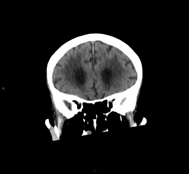 File:Cerebral amyloid angiopathy-associated lobar intracerebral hemorrhage (Radiopaedia 58530-65688 Coronal non-contrast 49).jpg
