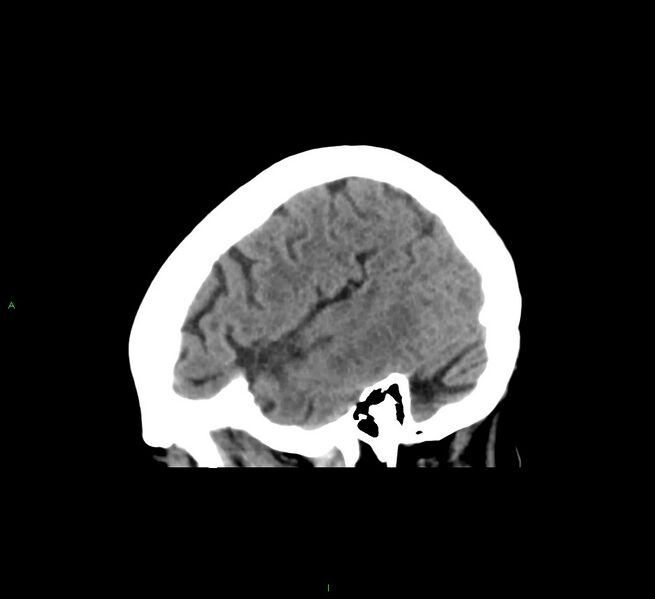 File:Cerebral amyloid angiopathy-associated lobar intracerebral hemorrhage (Radiopaedia 58563-65727 C 42).jpg