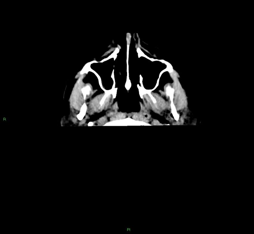 Cerebral amyloid angiopathy-associated lobar intracerebral hemorrhage (Radiopaedia 58756-65977 Axial non-contrast 52).jpg