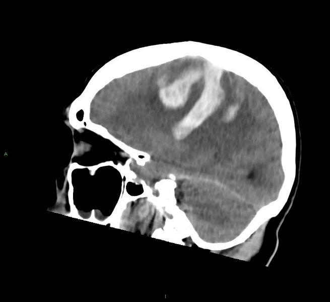 File:Cerebral amyloid angiopathy-associated lobar intracerebral hemorrhage (Radiopaedia 58756-65977 C 23).jpg