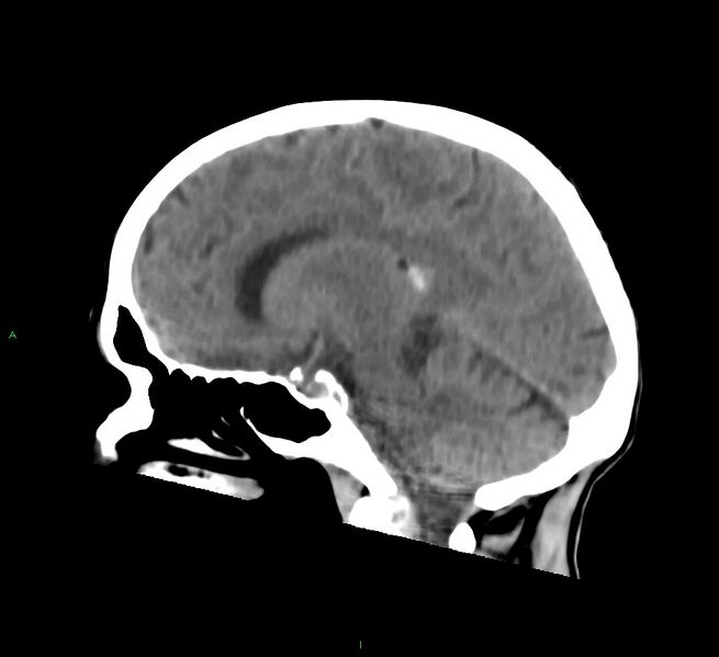 File:Cerebral amyloid angiopathy-associated lobar intracerebral hemorrhage (Radiopaedia 58758-65980 C 25).jpg