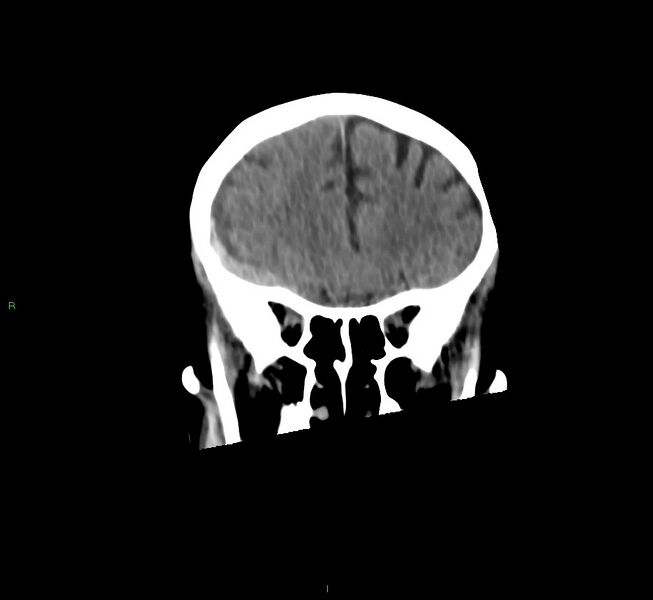 File:Cerebral amyloid angiopathy-associated lobar intracerebral hemorrhage (Radiopaedia 58758-65980 Coronal non-contrast 47).jpg