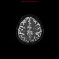 Cerebral and orbital tuberculomas (Radiopaedia 13308-13311 Axial T2 17).jpg