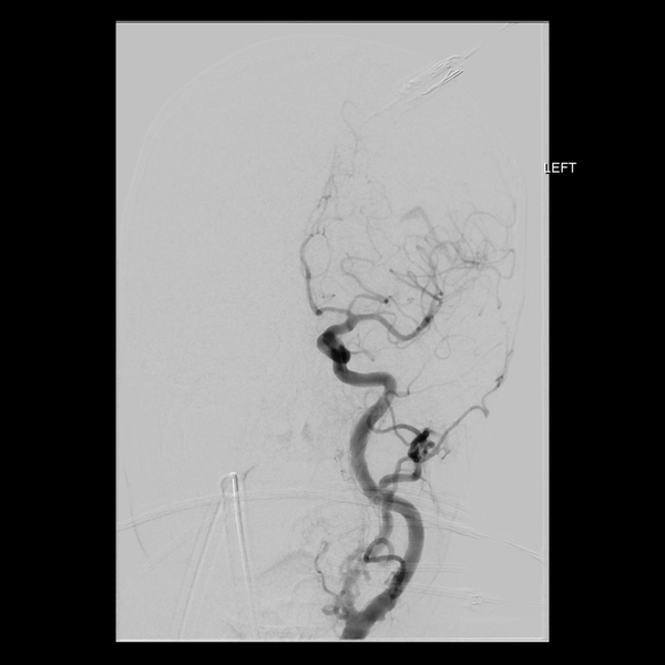 File:Cerebral arteriovenous malformation with lobar hemorrhage (Radiopaedia 44725-48513 LT CCA IC 12).png