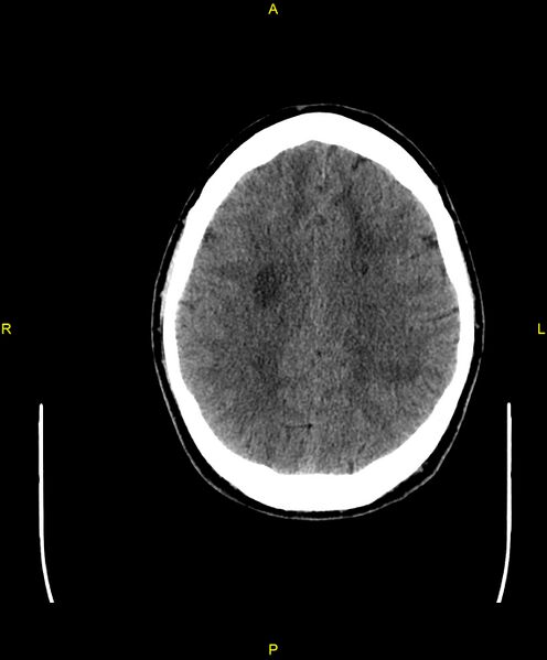 File:Cerebral autosomal dominant arteriopathy with subcortical infarcts and leukoencephalopathy (CADASIL) (Radiopaedia 86108-102051 Axial non-contrast 77).jpg