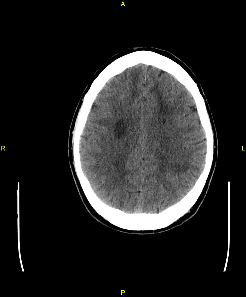 Cerebral autosomal dominant arteriopathy with subcortical infarcts and leukoencephalopathy (CADASIL) (Radiopaedia 86108-102051 Axial non-contrast 77).jpg