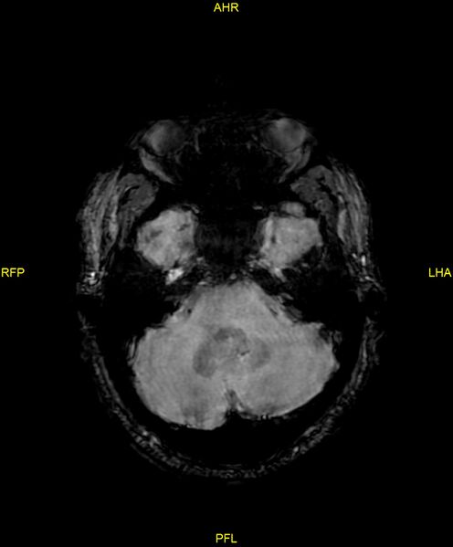 File:Cerebral autosomal dominant arteriopathy with subcortical infarcts and leukoencephalopathy (CADASIL) (Radiopaedia 86108-102054 Axial SWI 29).jpg