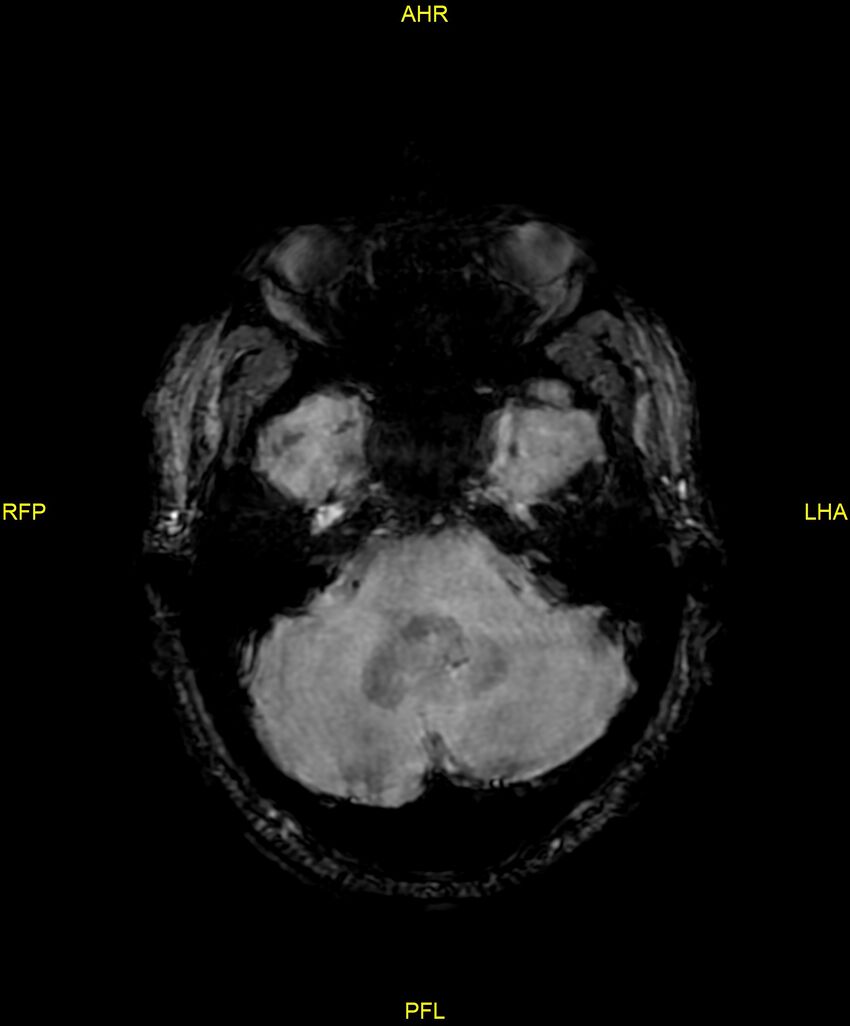 Cerebral autosomal dominant arteriopathy with subcortical infarcts and leukoencephalopathy (CADASIL) (Radiopaedia 86108-102054 Axial SWI 29).jpg