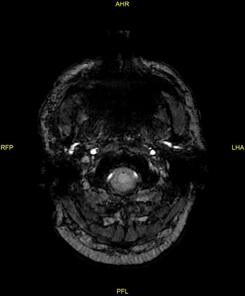 File:Cerebral autosomal dominant arteriopathy with subcortical infarcts and leukoencephalopathy (CADASIL) (Radiopaedia 86108-102054 Axial SWI 7).jpg