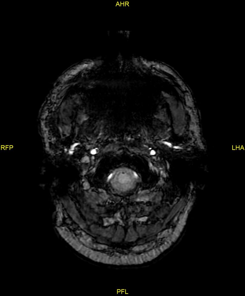Cerebral autosomal dominant arteriopathy with subcortical infarcts and leukoencephalopathy (CADASIL) (Radiopaedia 86108-102054 Axial SWI 7).jpg