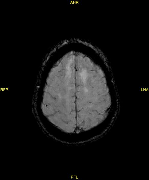 File:Cerebral autosomal dominant arteriopathy with subcortical infarcts and leukoencephalopathy (CADASIL) (Radiopaedia 86108-102054 Axial SWI 88).jpg