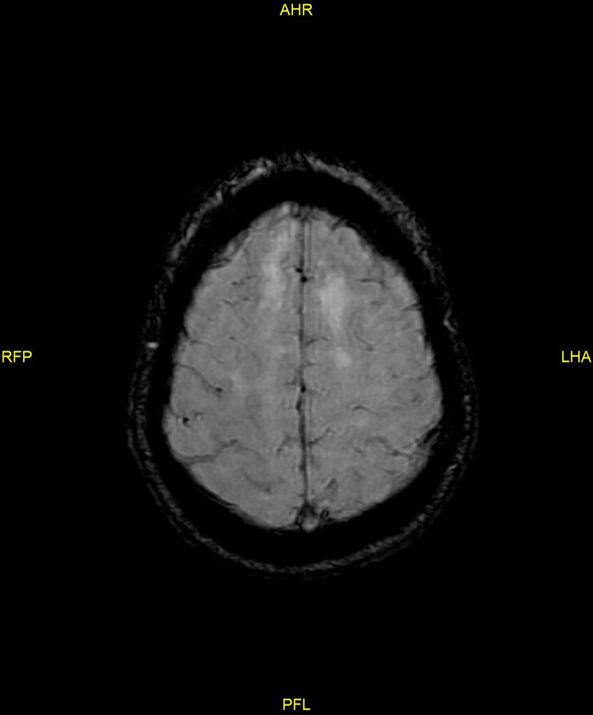 Cerebral autosomal dominant arteriopathy with subcortical infarcts and leukoencephalopathy (CADASIL) (Radiopaedia 86108-102054 Axial SWI 88).jpg